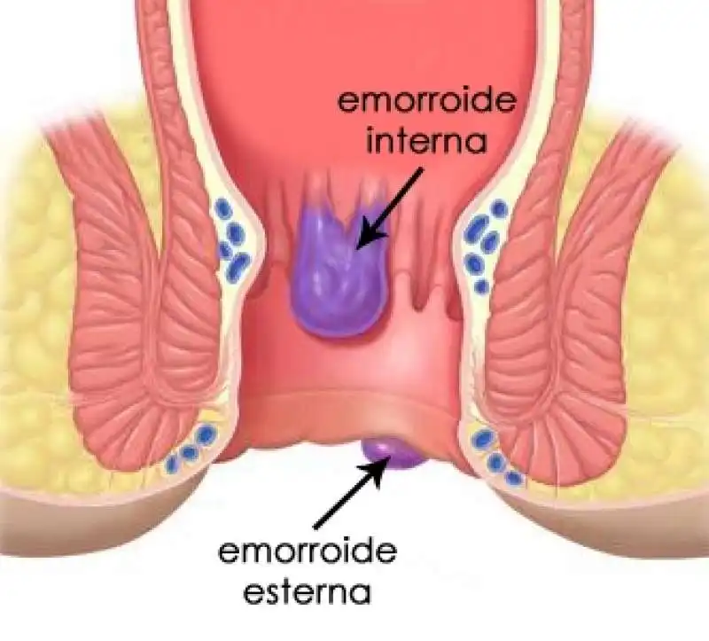 emorroidi