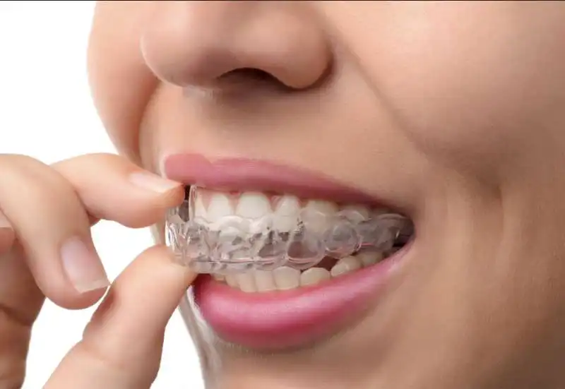 aligner apparecchio invisibile per denti 2