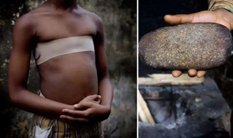 breast ironing   lo stiramento del seno 17