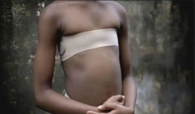 breast ironing   lo stiramento del seno 3