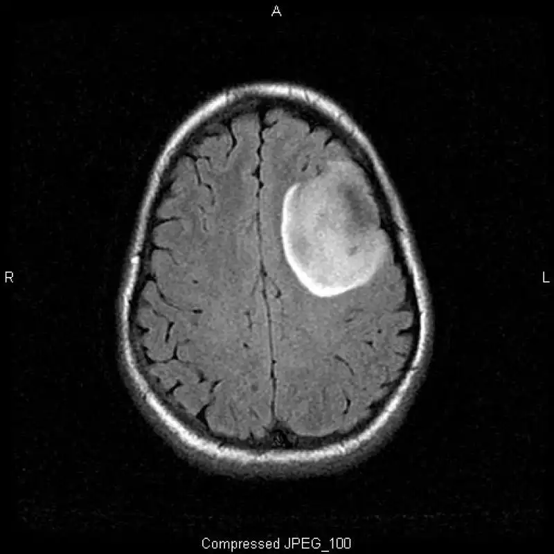 glioma 1