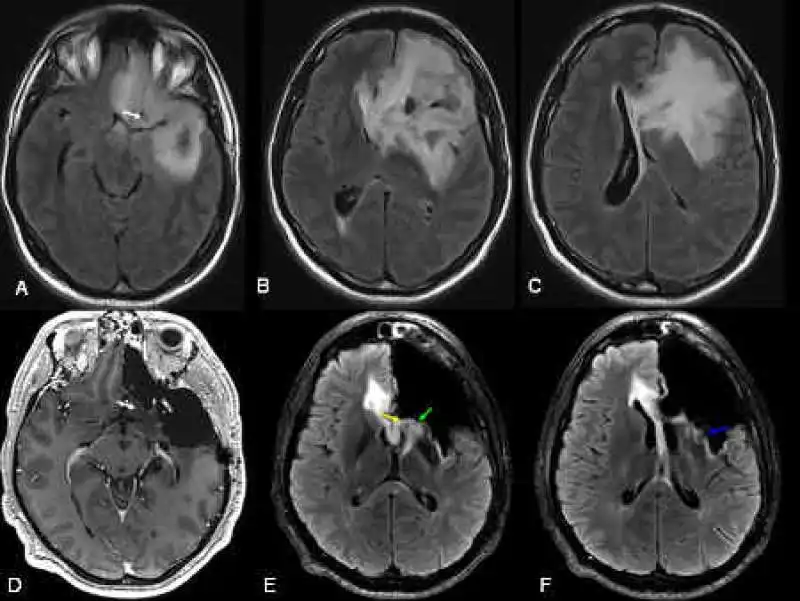 glioma 6