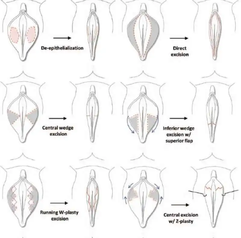 LABIOPLASTICA