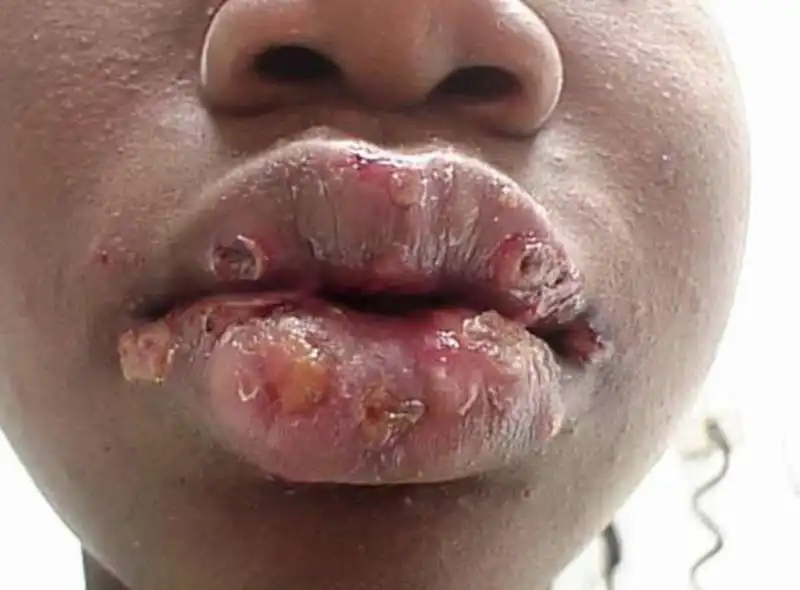 herpes 1