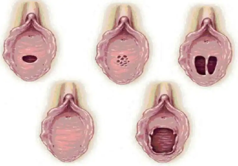 imenoplastica