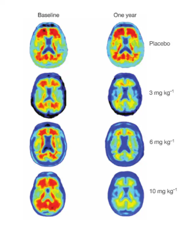 aducanumab contro alzheimer 1