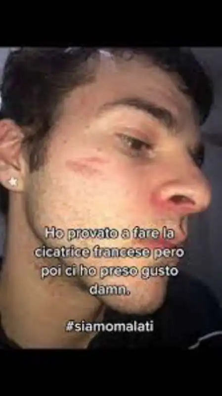 cicatrice francese su tiktok