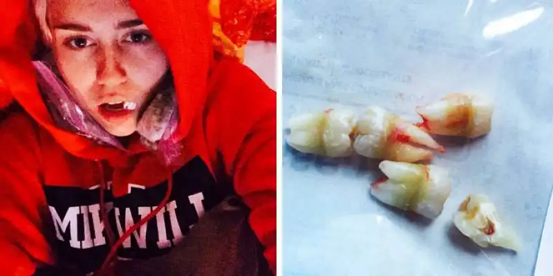 miley cyrus denti  del giudizio