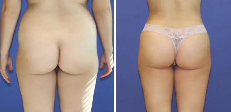 LIPOFILLING - brazilian butt lift