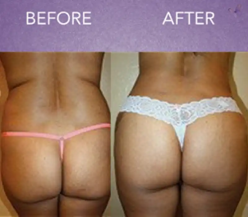 LIPOFILLING - brazilian butt lift  