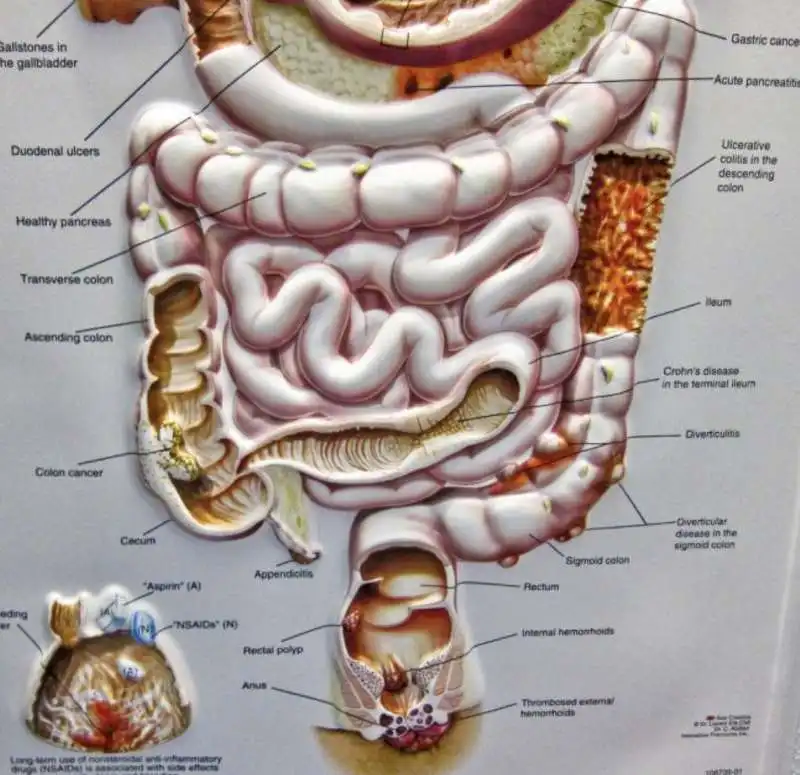 tumore al pancreas 11