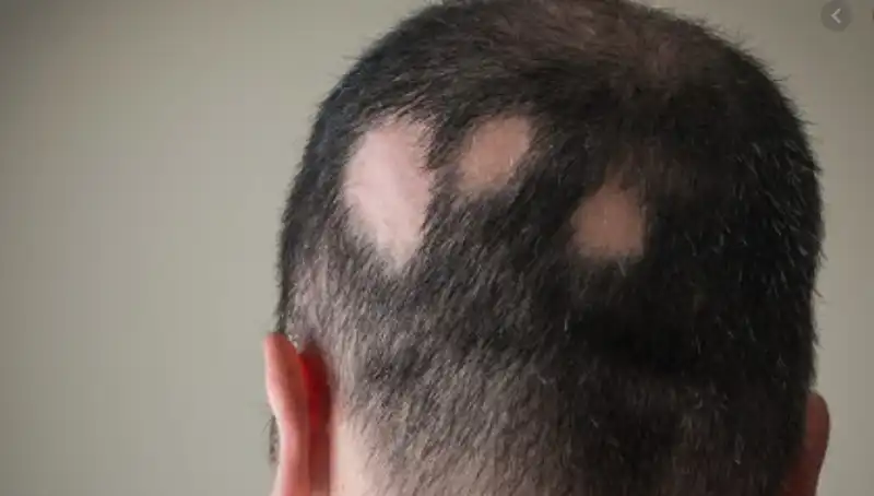 alopecia