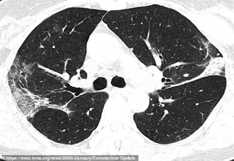 effetti del coronavirus sui polmoni 1