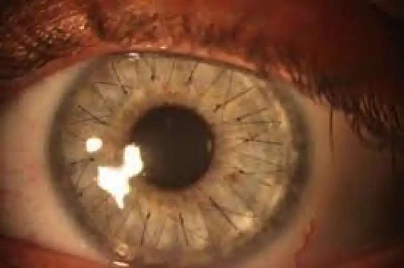 trapianto cornea 