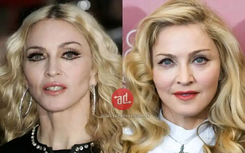 madonna e i filler