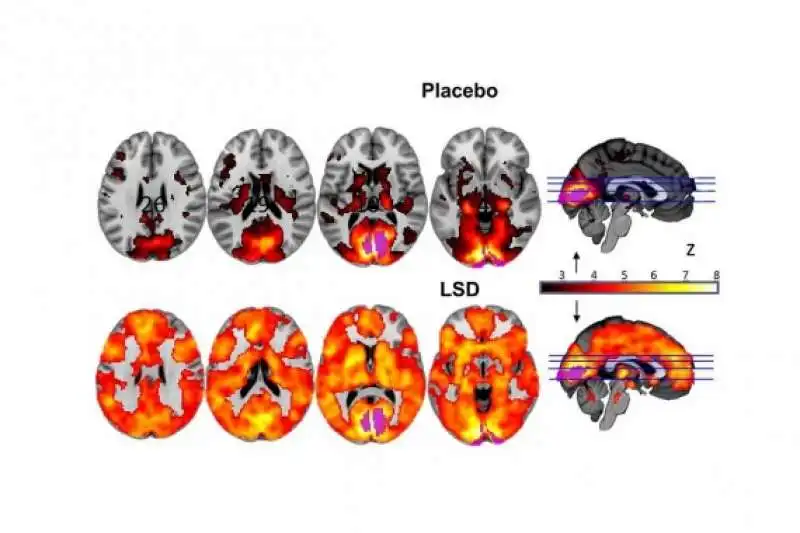 GLI EFFETTI DELLE DROGHE PSICHEDELICHE SUL CERVELLO  