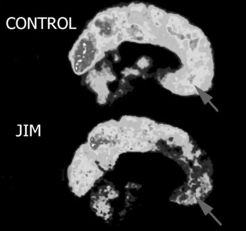 james fallon e lo scan del suo cervello