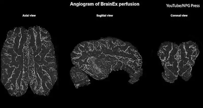 cervello di maiale riattivato dopo 4 ore dalla morte 4