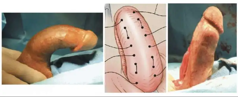 induratio penis   pene storto 4