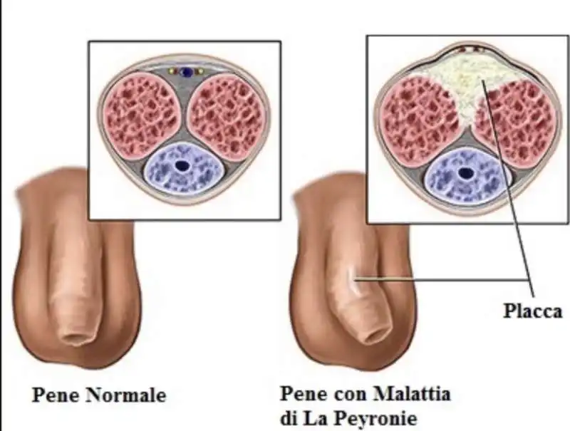 induratio penis   pene storto 7