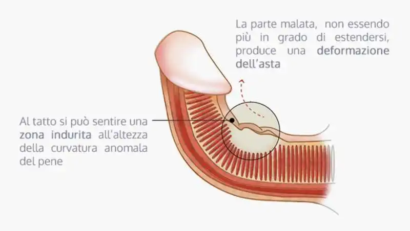 induratio penis   pene storto 8