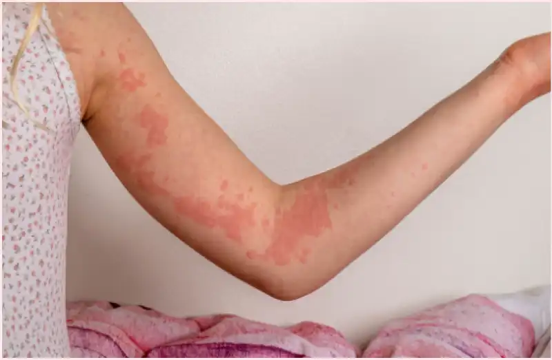 orticaria