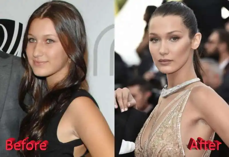 bella hadid  prima e dopo il chirurgo