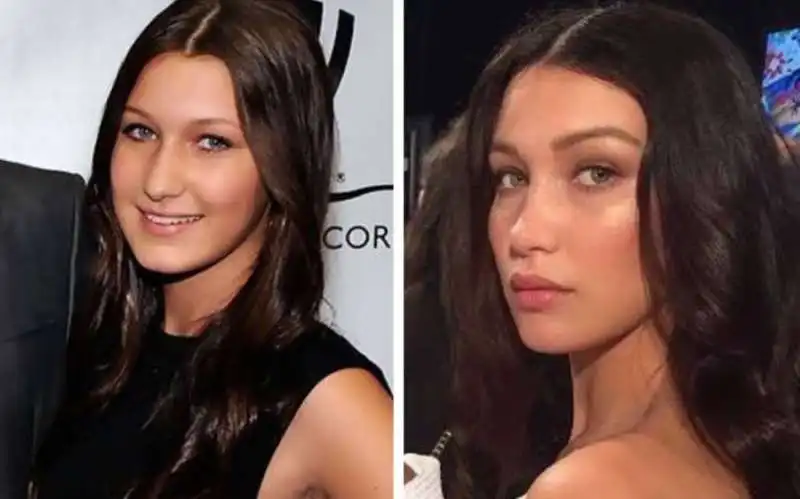 bella hadid prima e dopo