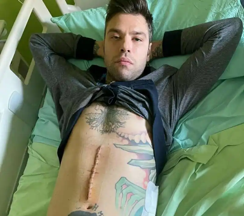 FEDEZ MOSTRA LA CICATRICE DOPO L'OPERAZIONE AL PANCREAS