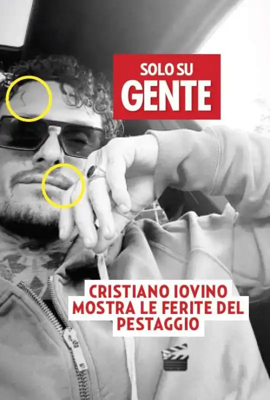 gente pubblica le foto delle ferite del pestaggio di cristiano iovino