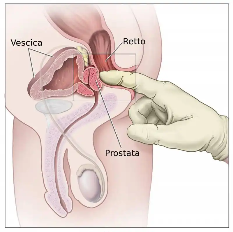 TUMORE ALLA PROSTATA