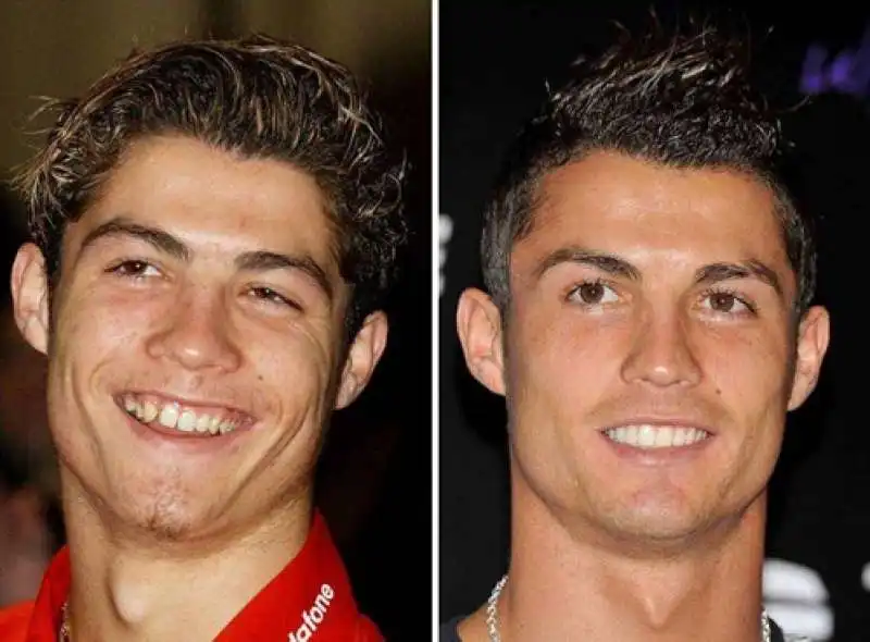 cristiano ronaldo prima e dopo la chirurgia