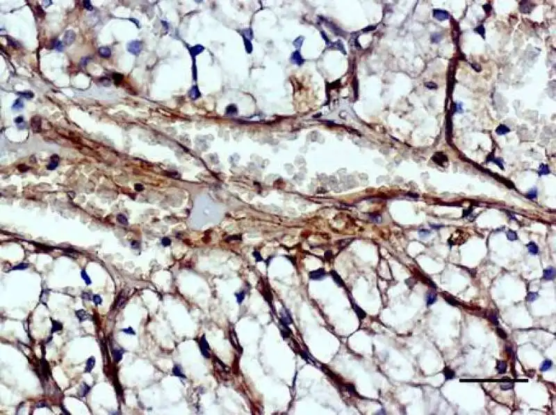 LA PROTEINA MICAL2 IN UN NUOVO VASO SANGUIGNO DI UN TUMORE AL RENE UMANO