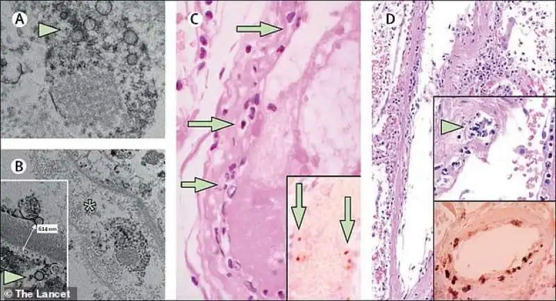 il coronavirus e i vasi sanguigni