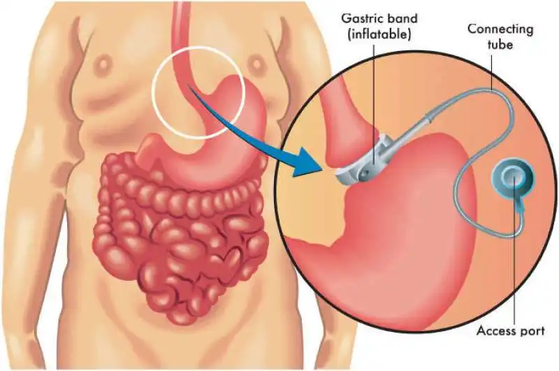 Chirurgia bariatrica contro l'obesità 2