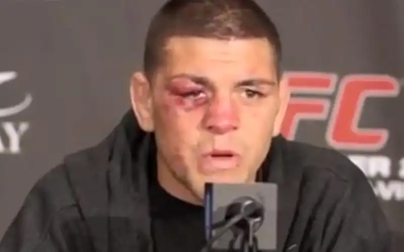 NICK DIAZ DOPO 