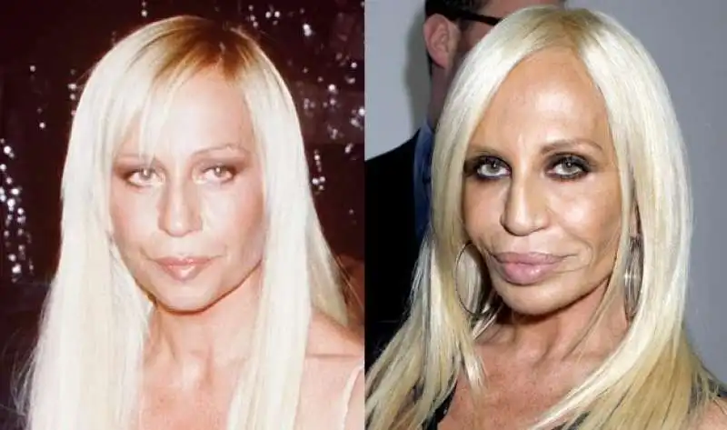 donatell versace prima e dopo