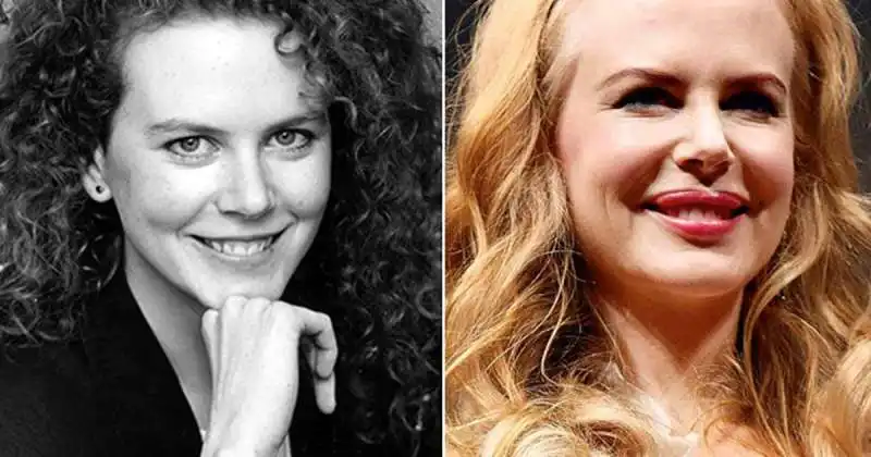 nicole kidman prima e dopo