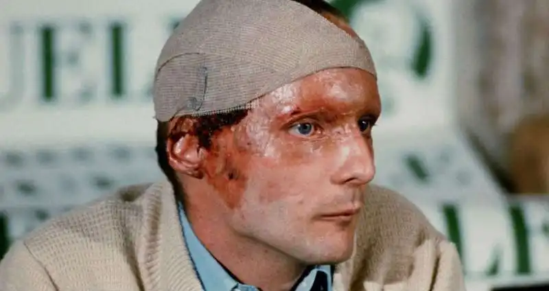 niki lauda dopo l incidente