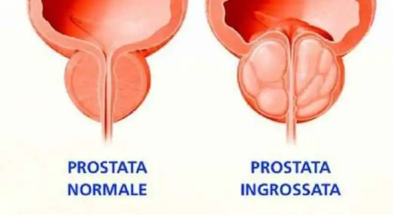 PROSTATA