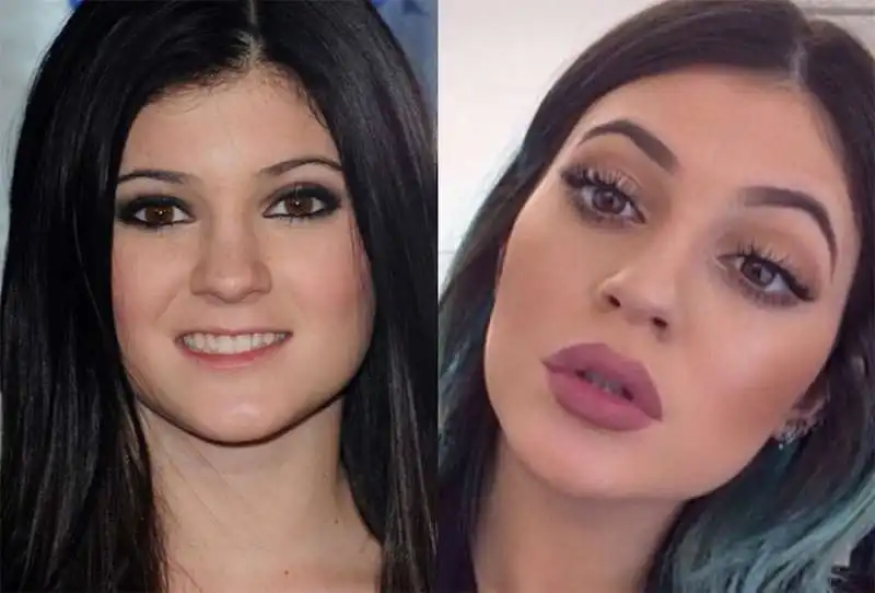 kylie jenner prima e dopo il chirurgo  2