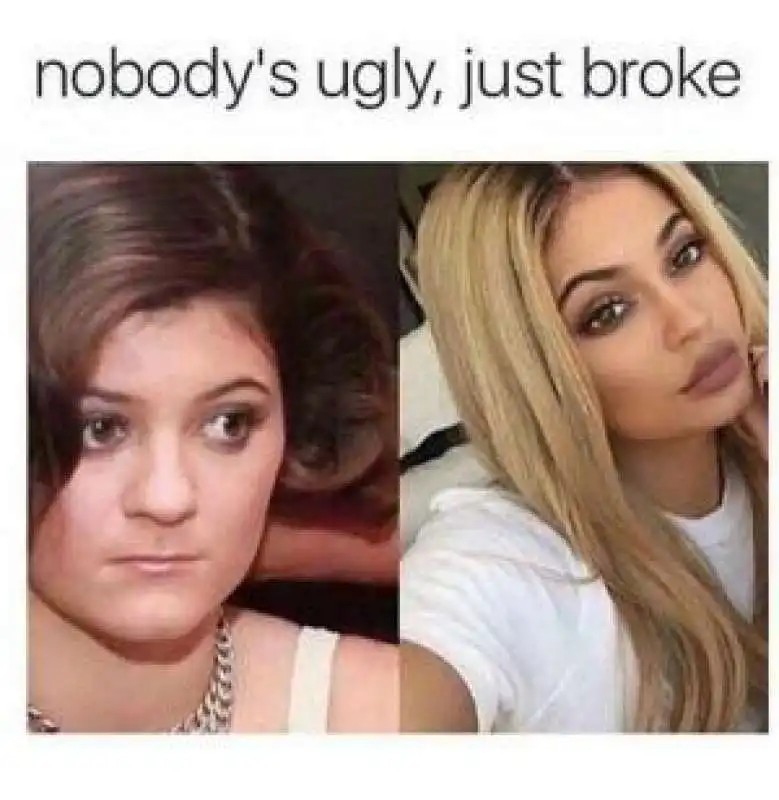 kylie jenner prima e dopo il chirurgo  3