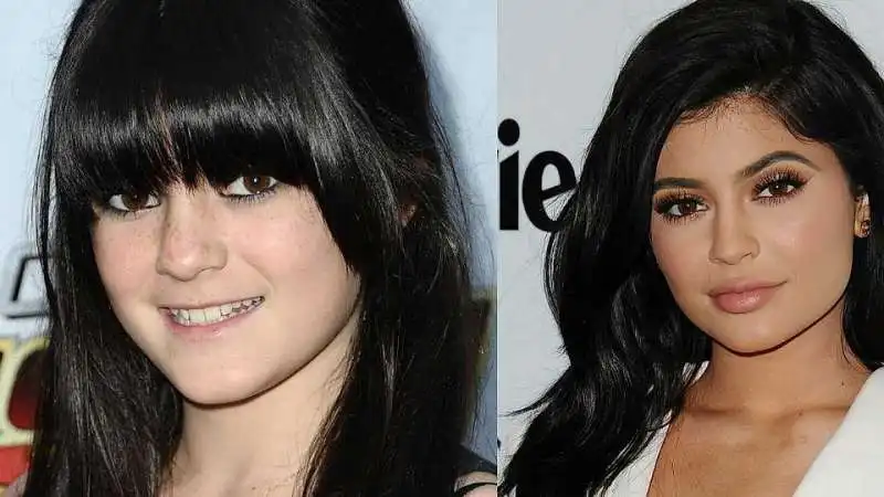 kylie jenner prima e dopo il chirurgo  6