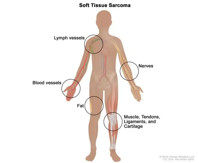 Sarcoma 