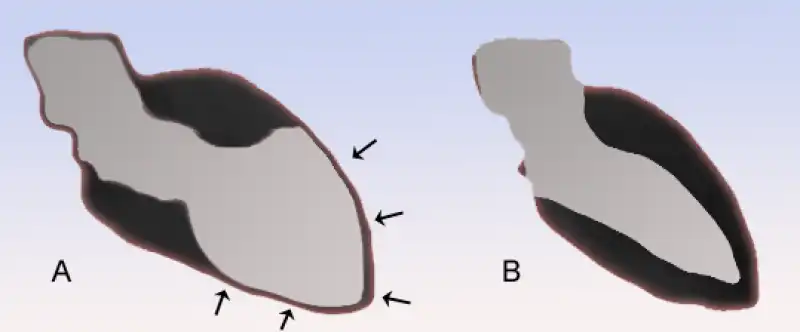 sindrome di tako tsubo o del cuore infranto 