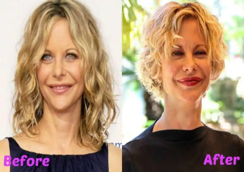 meg ryan troppa plastica 