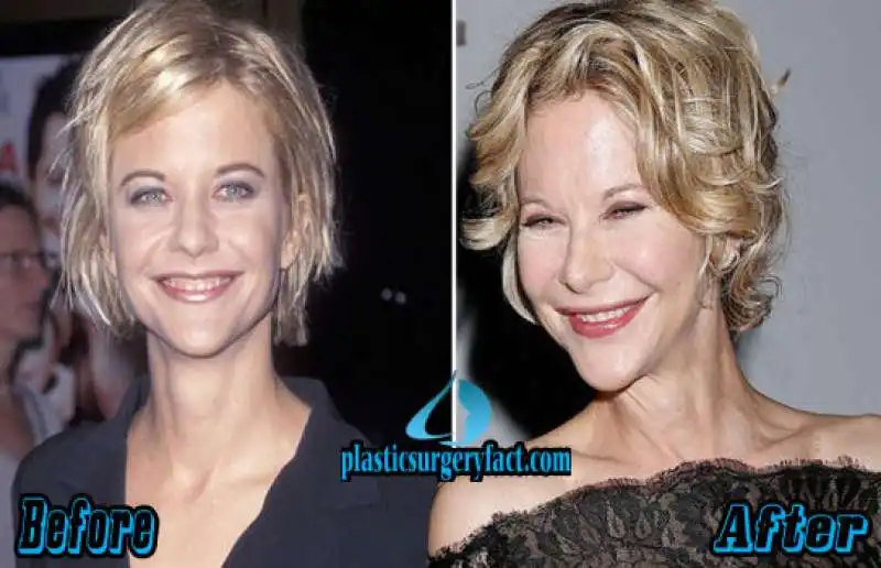 meg ryan troppa plastica 2