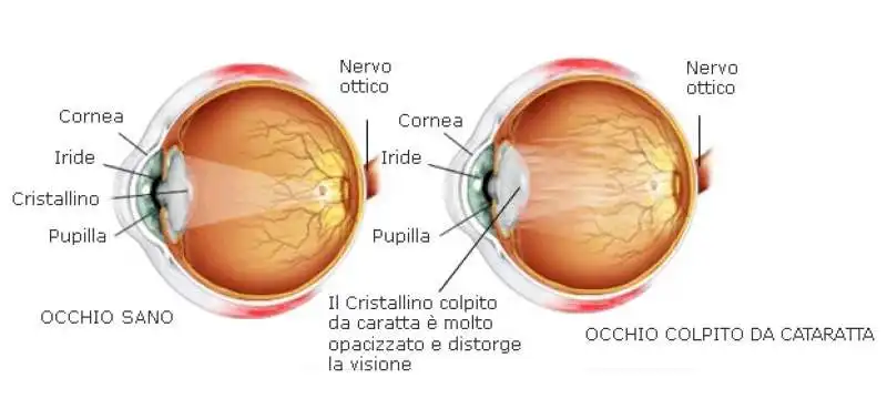 cataratta congenita  2