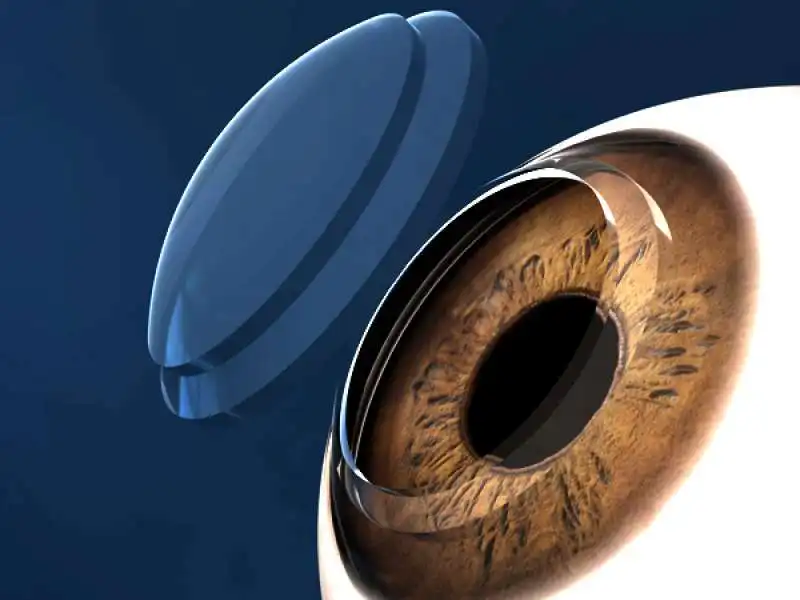 cornea artificiale 2