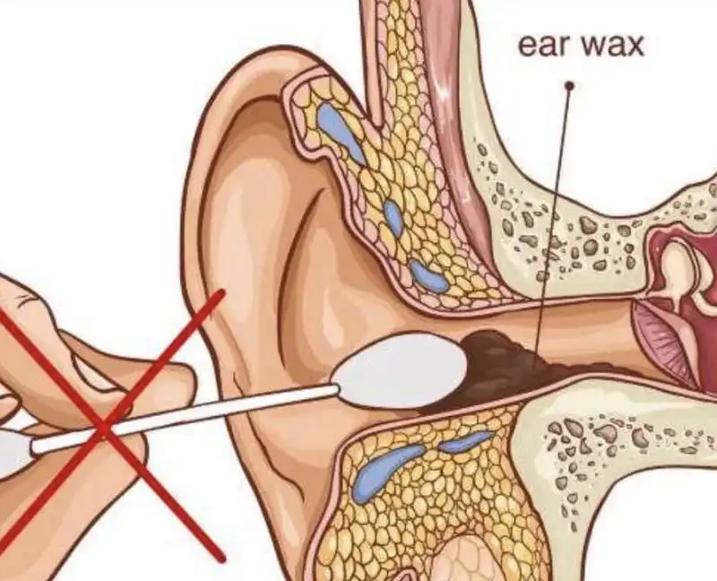 bastoncini cotonati e cerume  